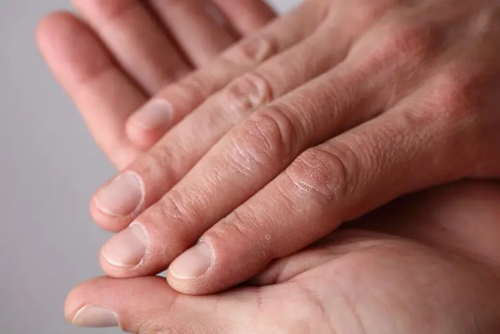 Chilblains
